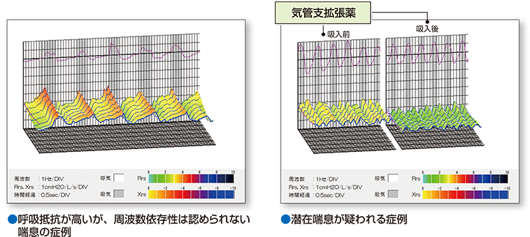 モストグラフ(気道抵抗性試験)